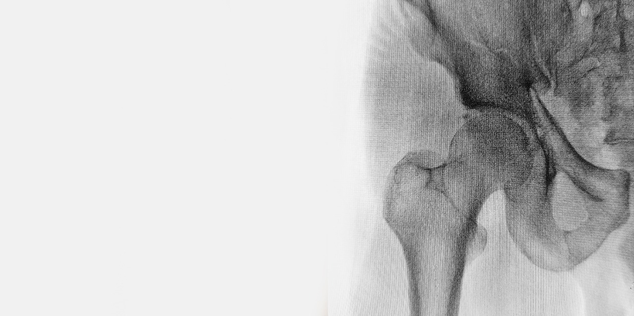radiographie de la hanche
